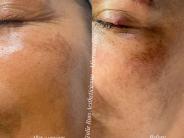 Microneedling Pigmentation